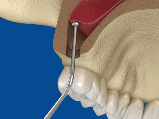 Sinus Lift Photo